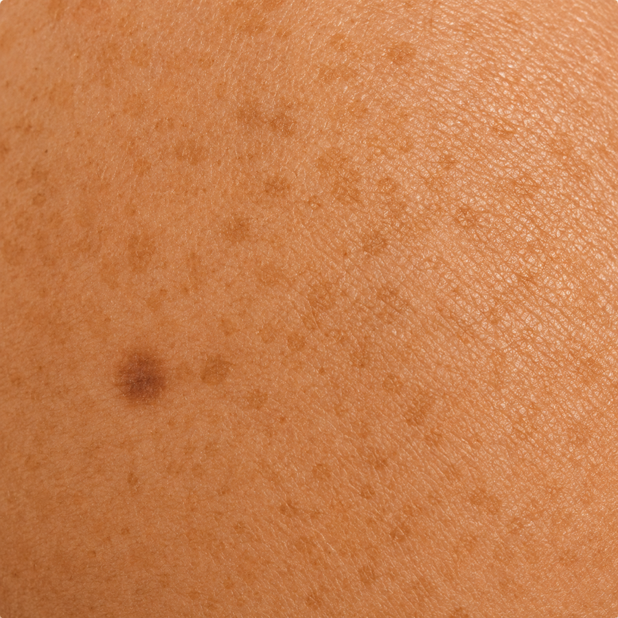 skin with sun damage