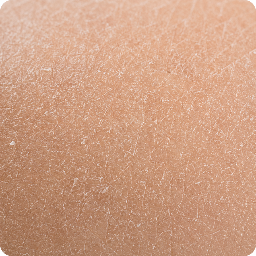 tight and dry skin